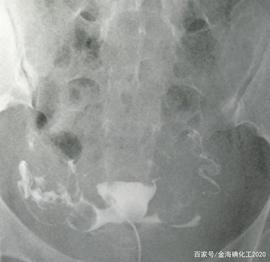 LITE:原料药在造影剂中所起的作用_MBE
