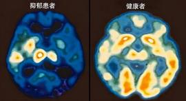DAS:抑郁症做正规治疗和吃药是康复捷径，也要做心理治疗和自我成长_SHIBLI