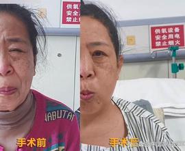 ION:病例：阿姨面抽6年，逢人就做“鬼脸”，颅内找到“越轨”的血管_PTER
